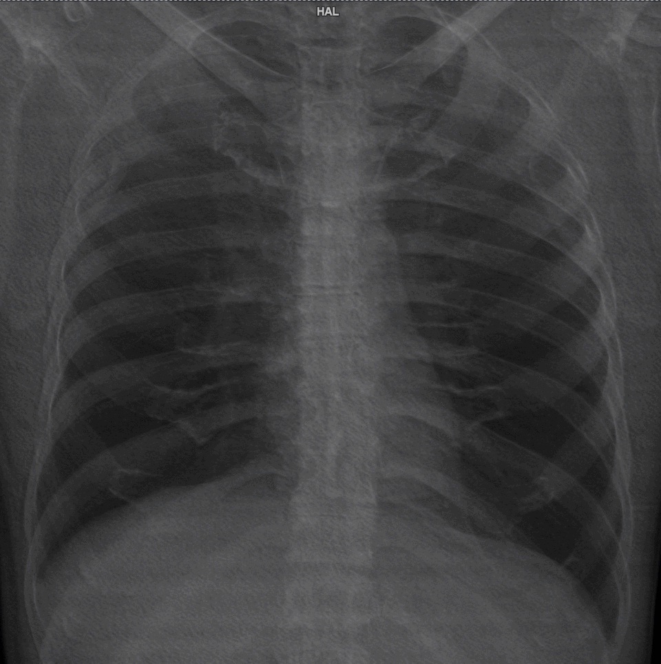 Datei:Projectional rendering of CT scan of thorax.gif